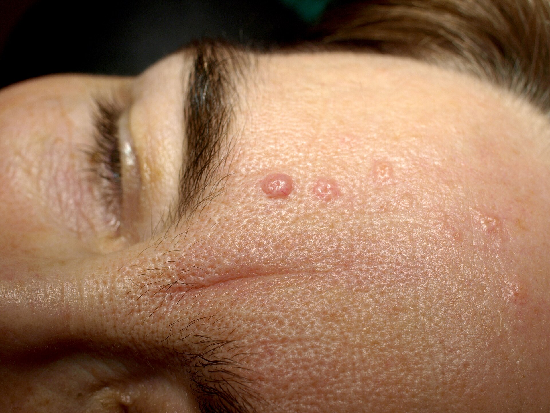 Imagem de referência de Dermatite seborreica, descrito nos dados abertos como doença cutânea que provoca manchas descamativas e vermelhas na pele, principalmente no couro cabeludo