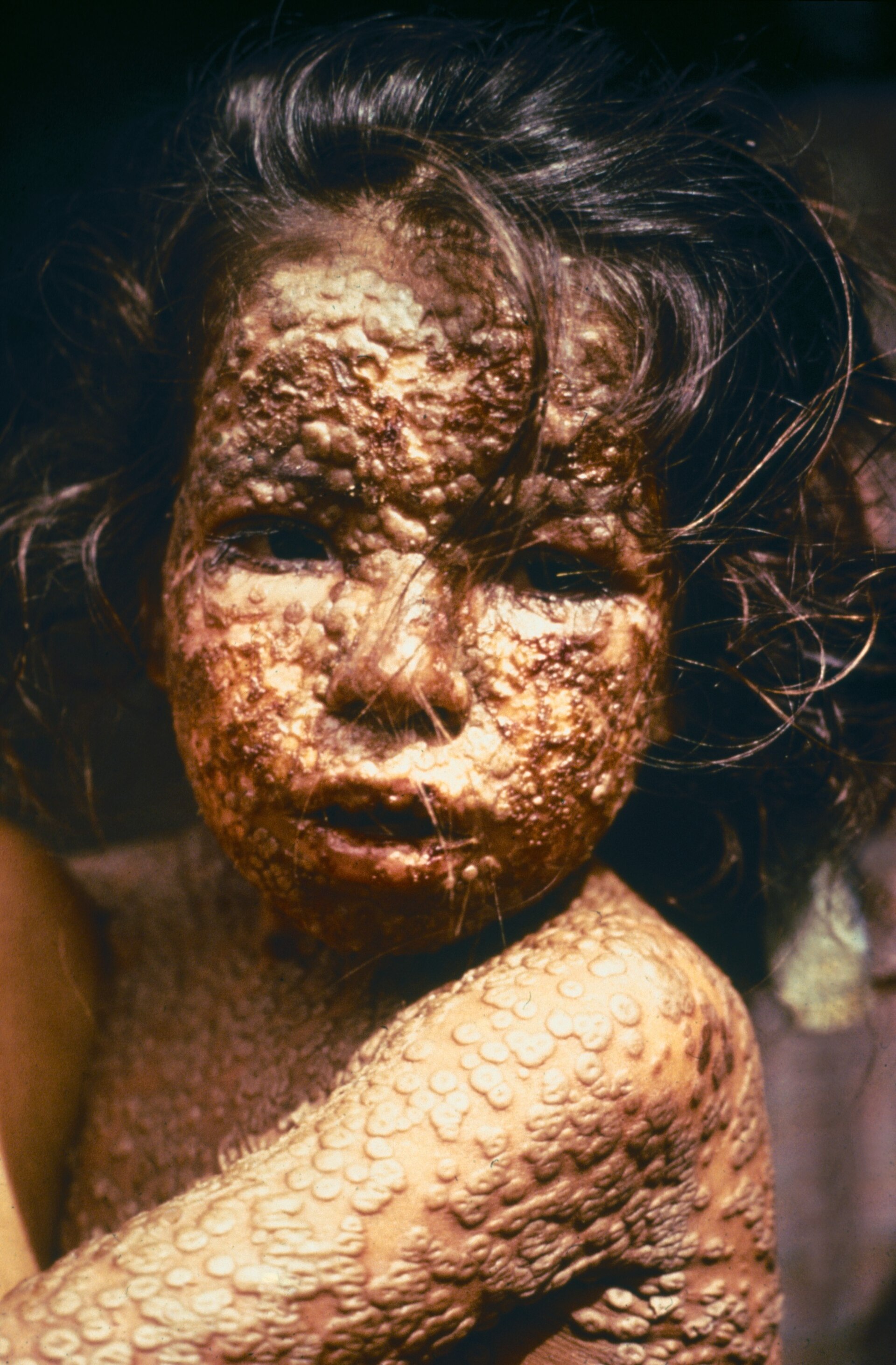 Imagem de referência de varíola, descrito nos dados abertos como doença infecciosa viral erradicada