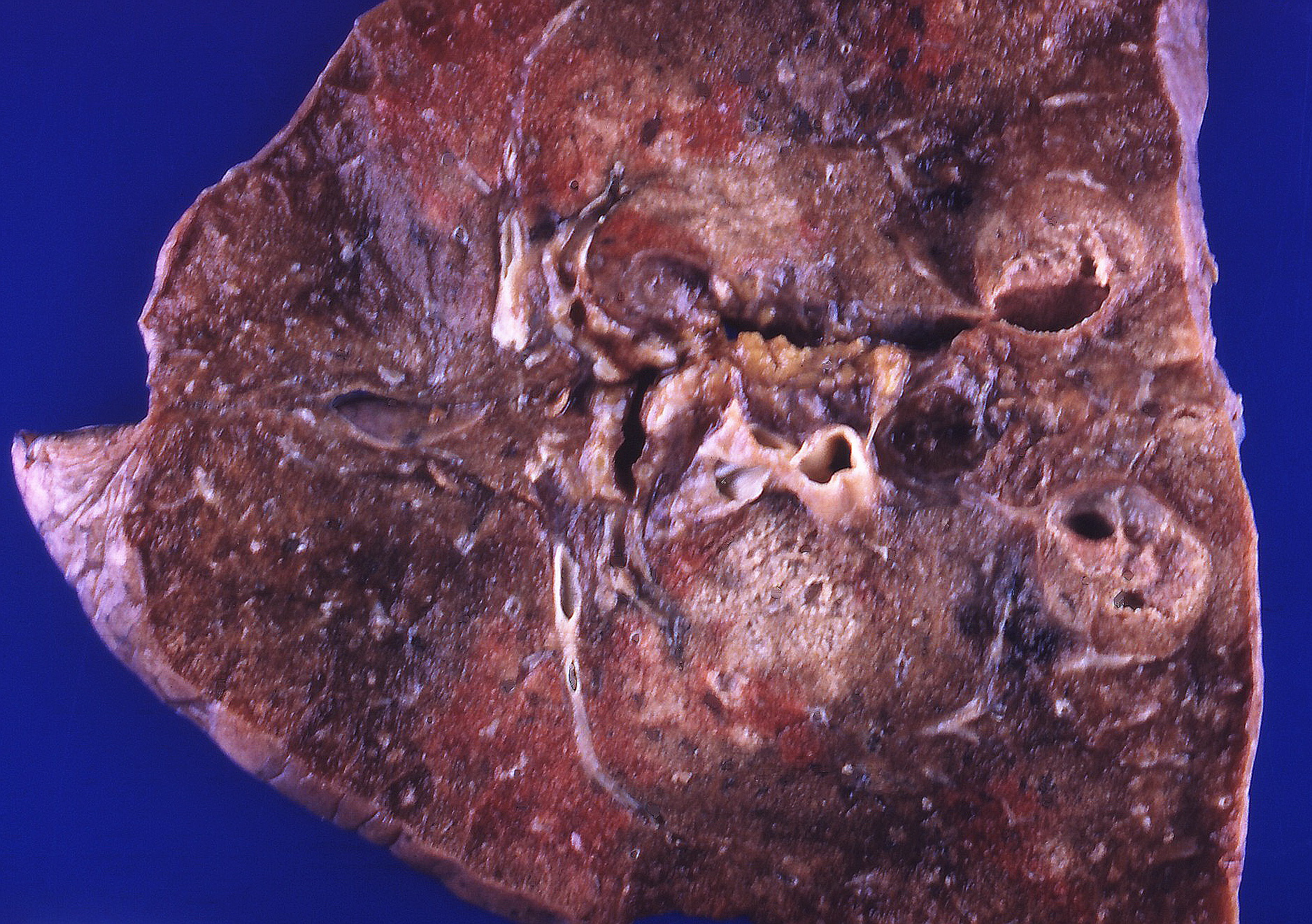 Imagem de referência de pneumonia por aspiração, descrito nos dados abertos como tipo de pneumonia que se desenvolve devido à entrada de materiais estranhos nos pulmões
