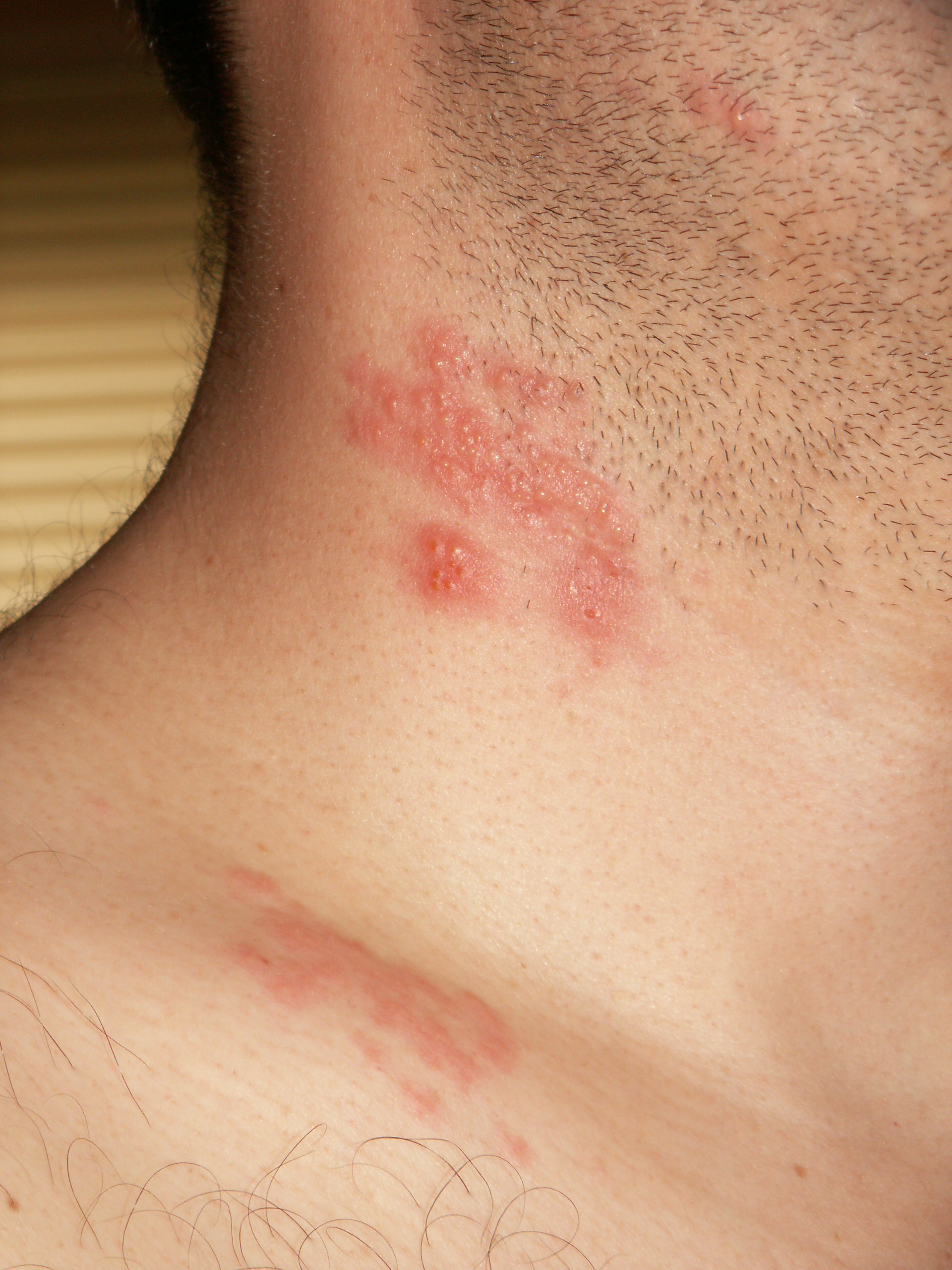 Imagem de referência de herpes-zóster, descrito nos dados abertos como doença viral causada pela reativação do vírus da Catapora