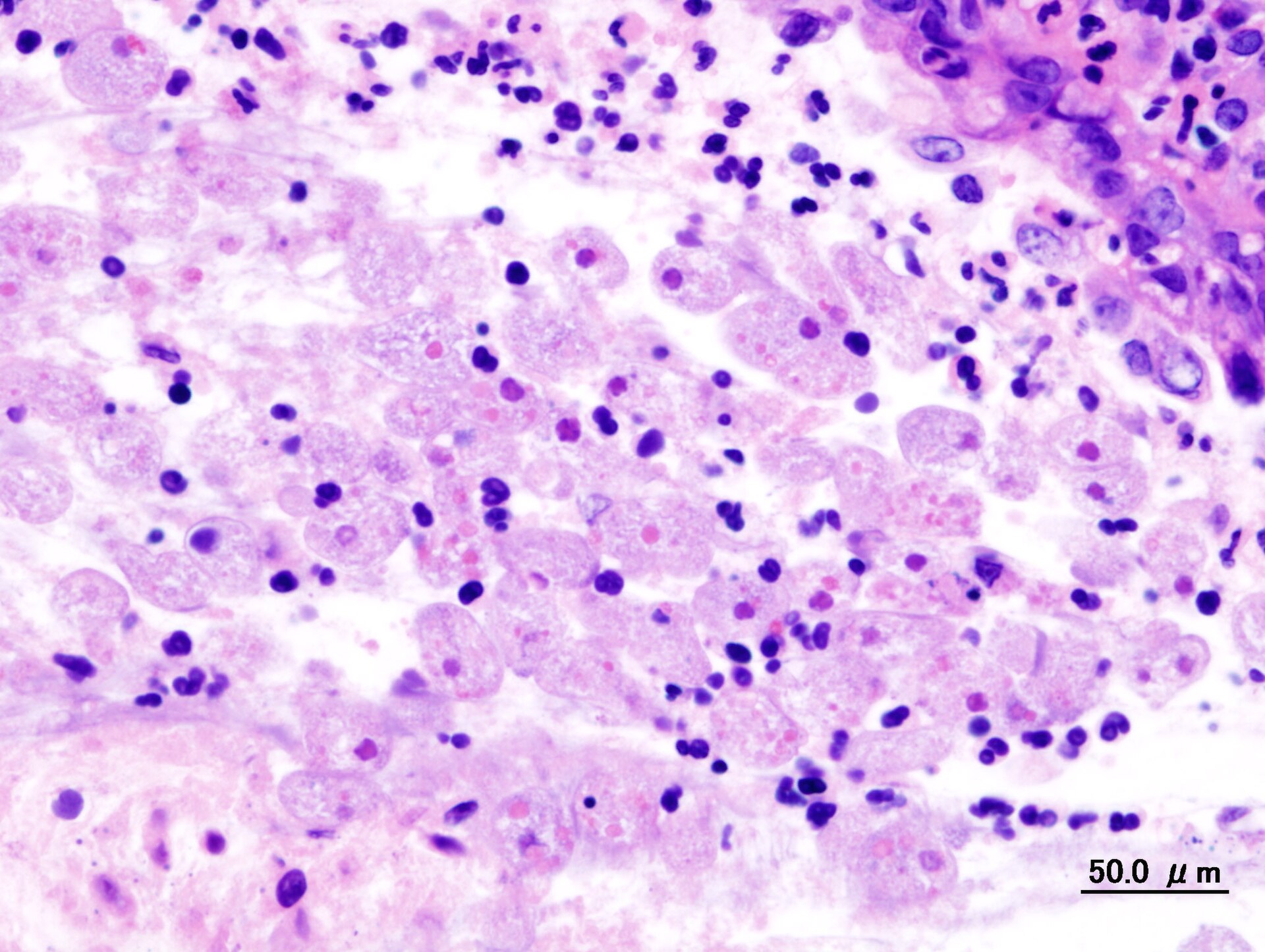 Imagem de referência de amebíase, descrito nos dados abertos como infeção causada por parasitas ameboides do género Entamoeba