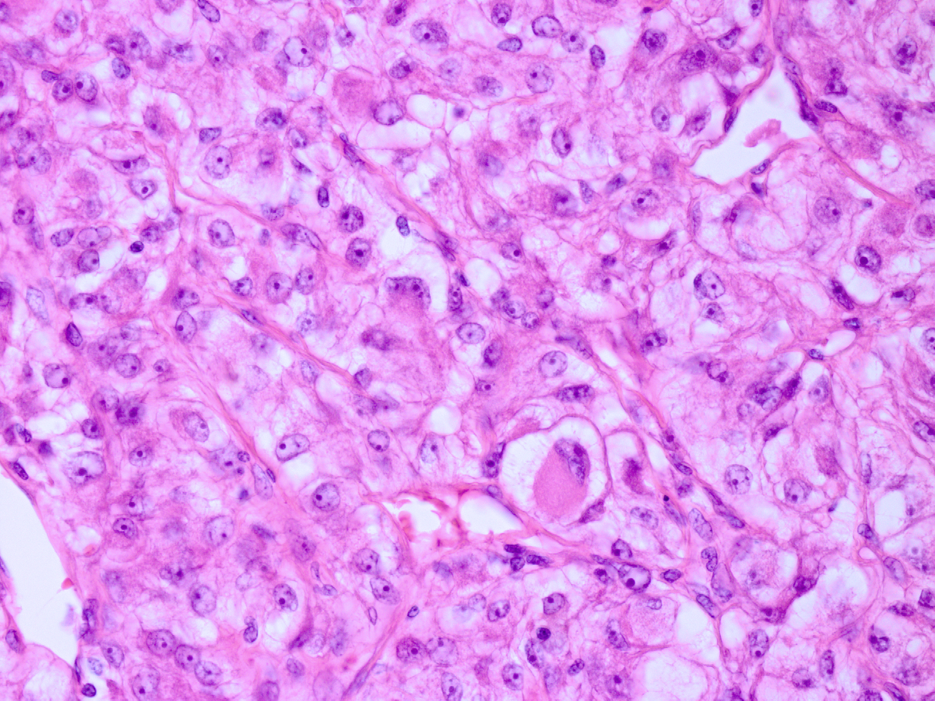 Imagem de referência de meningioma, descrito nos dados abertos como inflamação na membrana