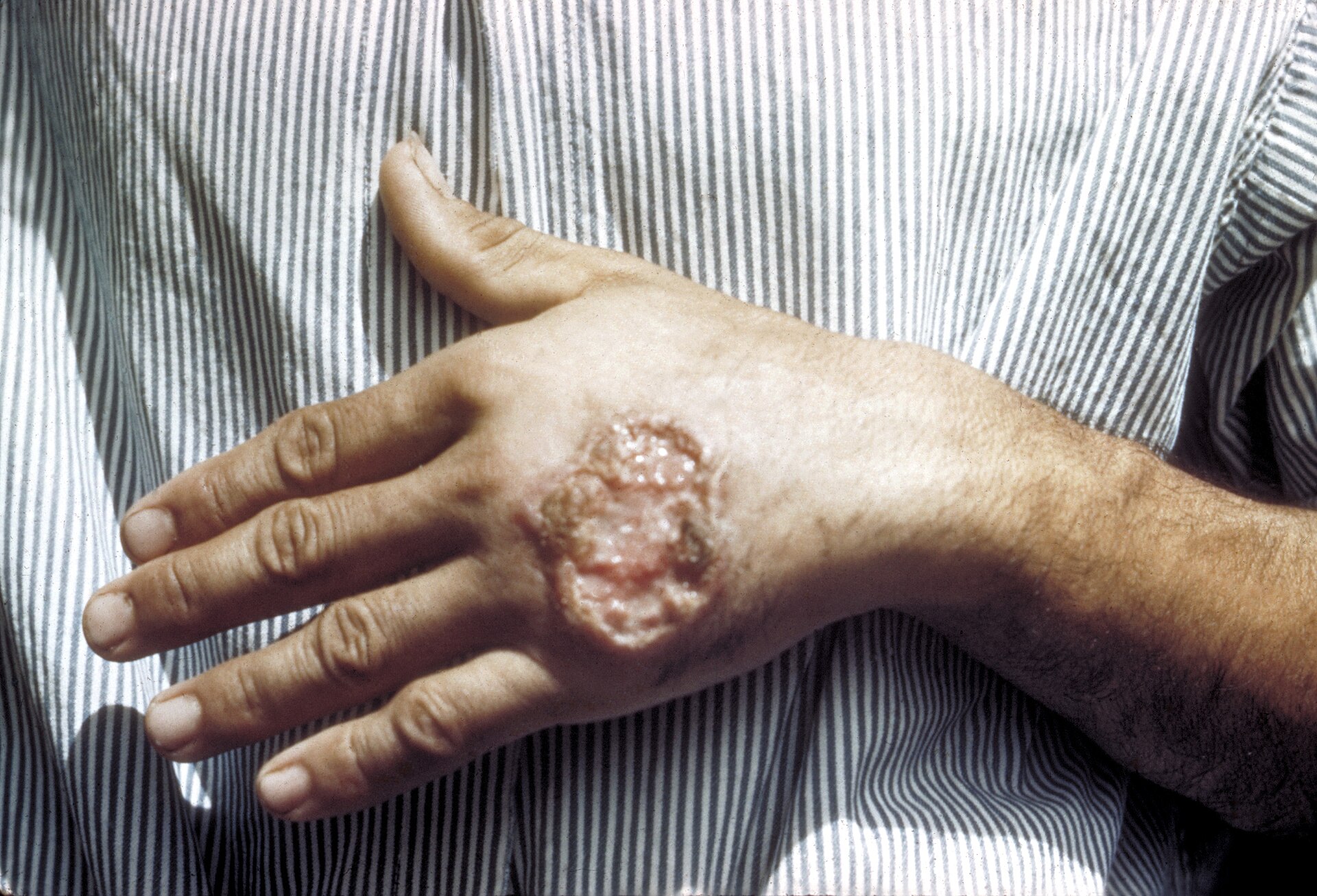 Imagem de referência de leishmaniose, descrito nos dados abertos como doença causada por parasitas do gênero Leishmania