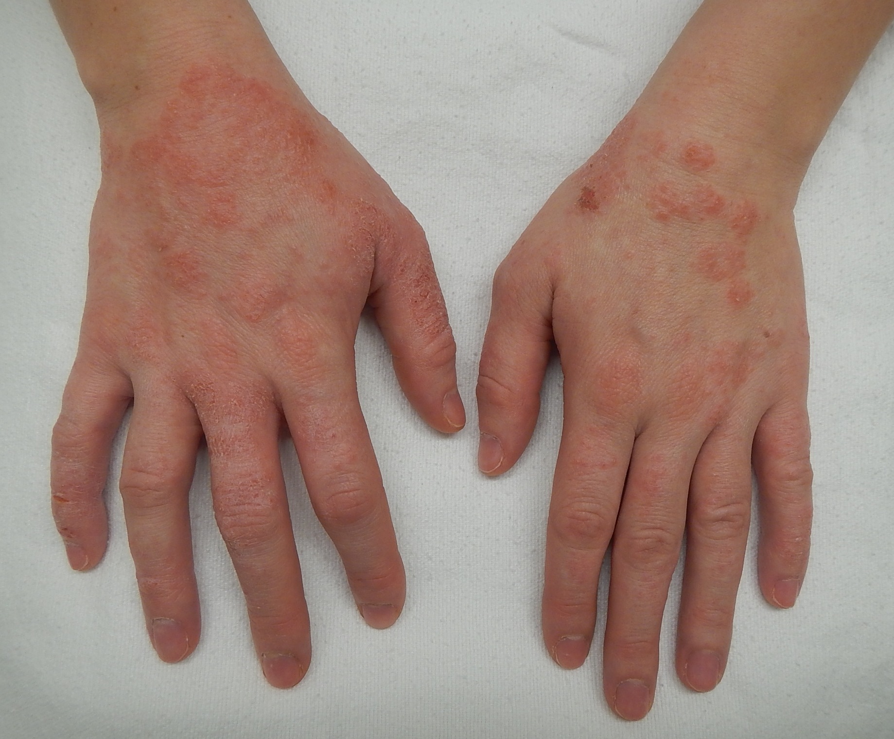 Imagem de referência de dermatite, descrito nos dados abertos como doenças que causam inflamação da pele