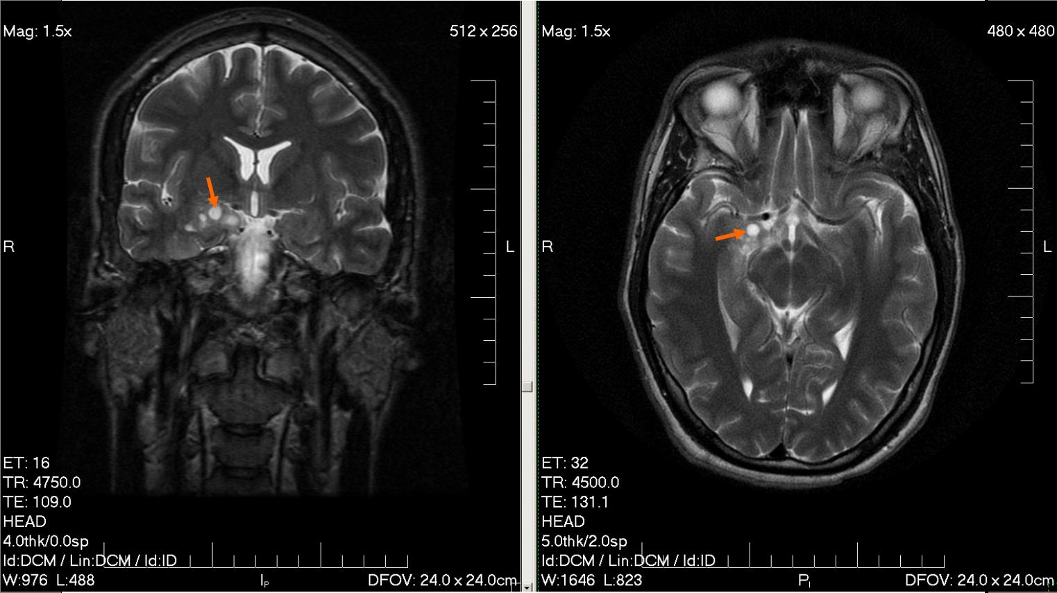 Imagem de referência de glioma, descrito nos dados abertos como tipo de tumor que começa no cérebro ou na espinha