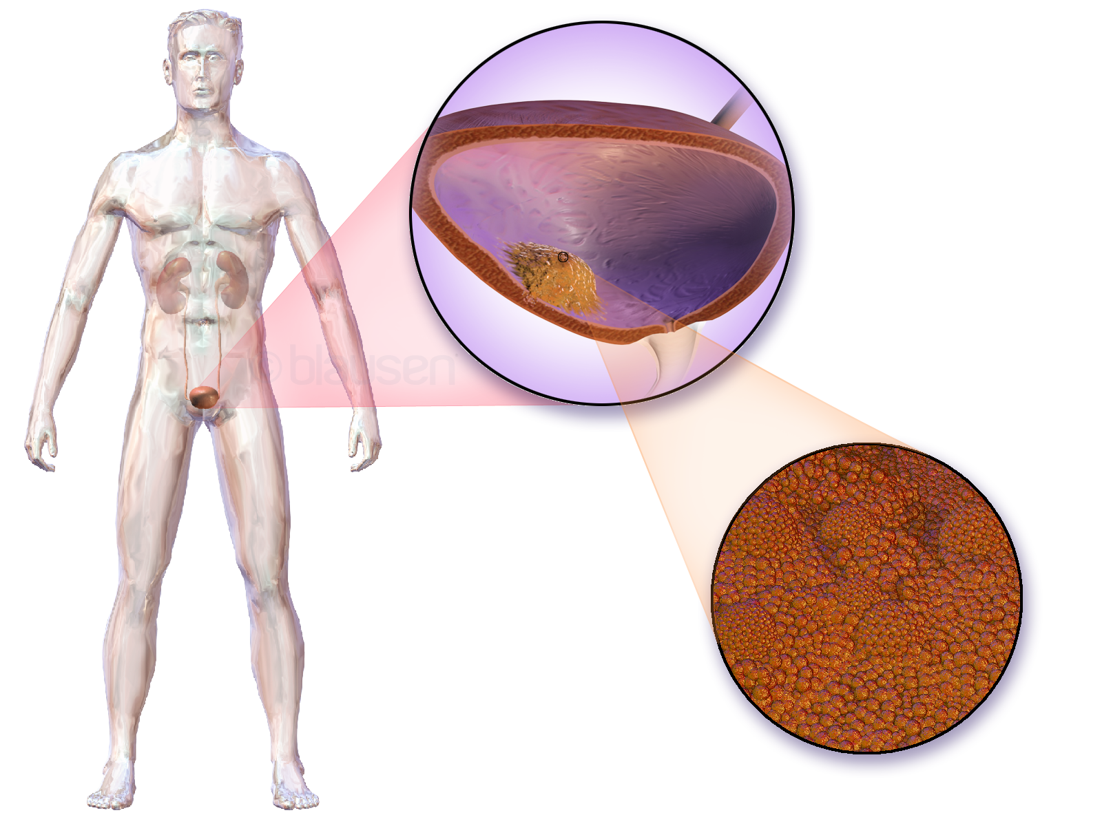 Imagem de referência de cancro da bexiga, descrito nos dados abertos como tumor maligno que surge na bexiga