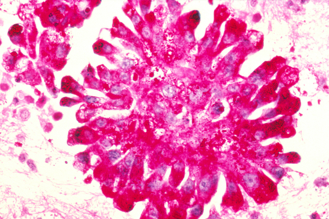 Imagem de referência de Sarcoma de Ewing, descrito nos dados abertos como tipo de câncer