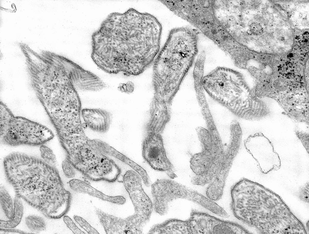 Imagem de referência de parotidite infecciosa, descrito nos dados abertos como doença humana viral e contagiosa