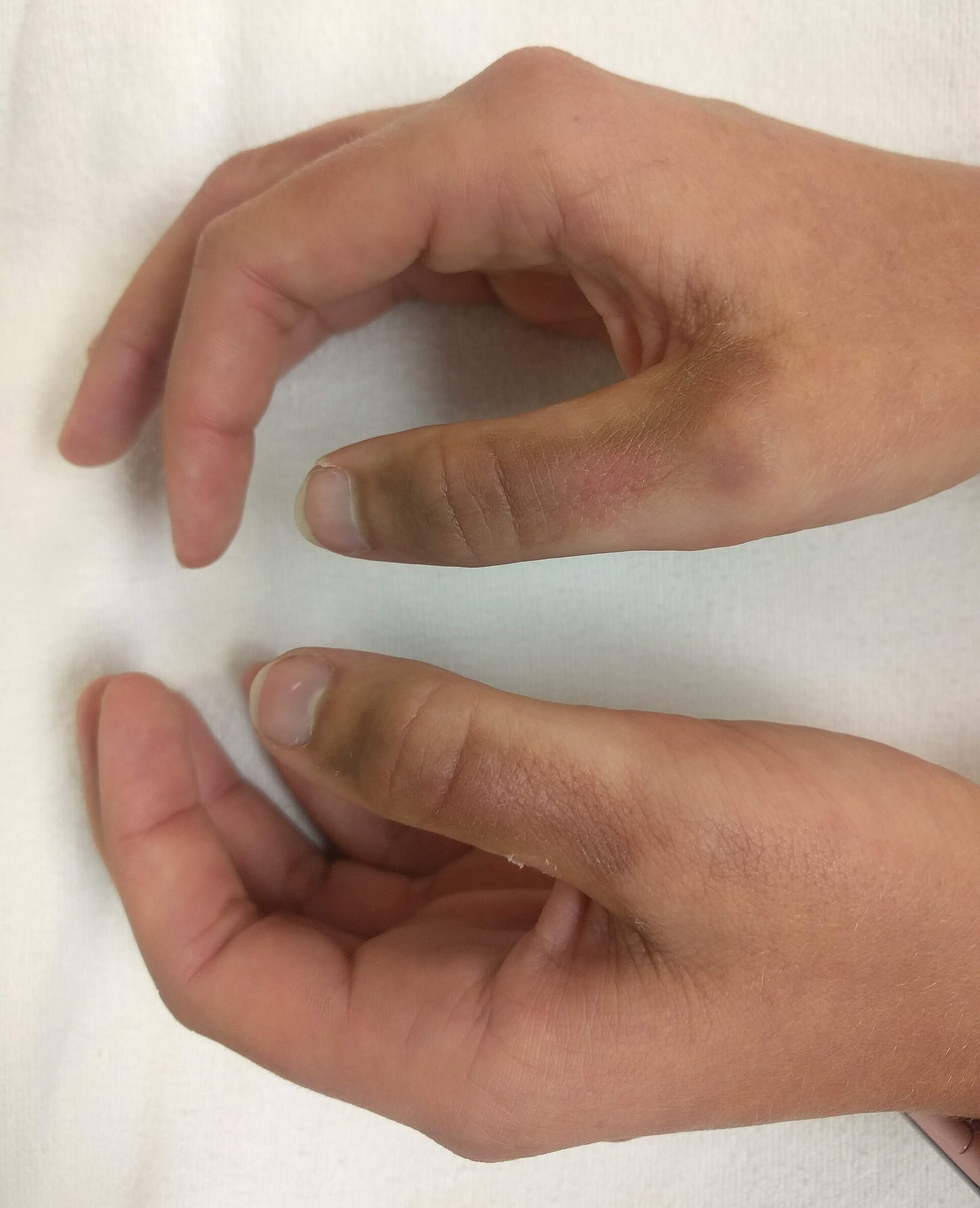 Imagem de referência de fotodermatite, descrito nos dados abertos como reação inflamatória da pele ao sol