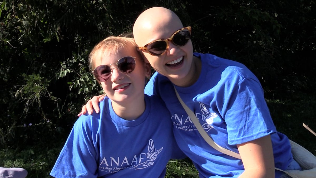 ‘She’s my best friend’: Alopecia awareness advocate mentoring young girls with hair loss condition