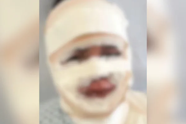 Fisioterapeuta é presa após jogar água quente em atual do ex em BH